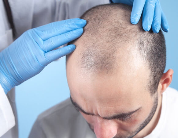 Hair Transplant